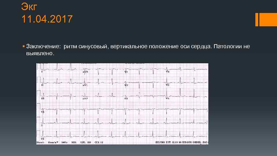 Экг 11. 04. 2017 § Заключение: ритм синусовый, вертикальное положение оси сердца. Патологии не