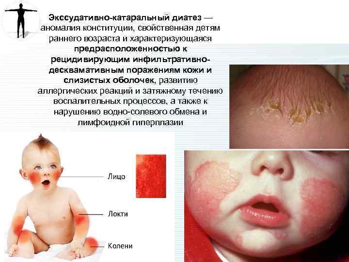 Экссудативно-катаральный диатез — аномалия конституции, свойственная детям раннего возраста и характеризующаяся предрасположенностью к рецидивирующим