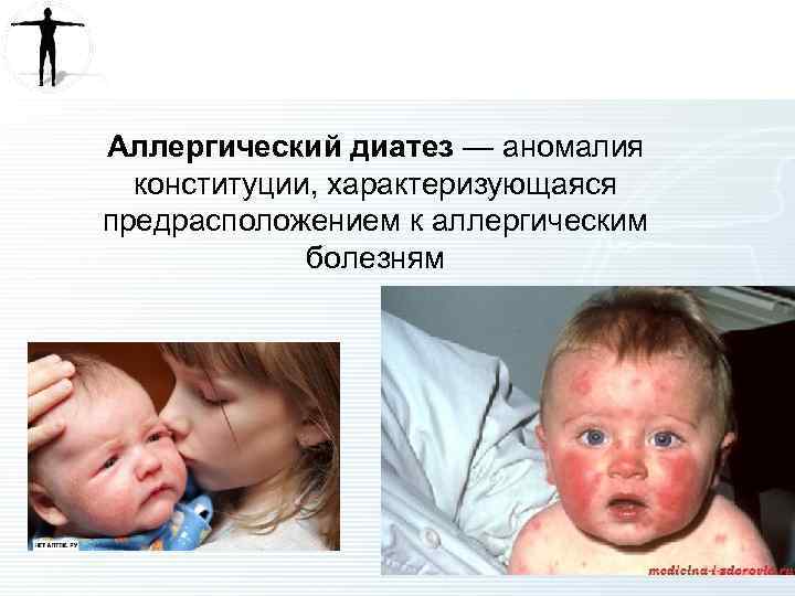 Аллергический диатез — аномалия конституции, характеризующаяся предрасположением к аллергическим болезням 