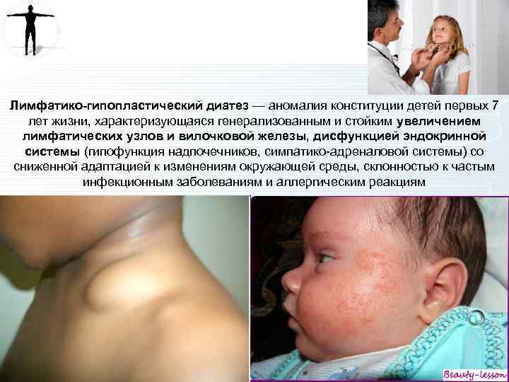 Лимфатико-гипопластический диатез — аномалия конституции детей первых 7 лет жизни, характеризующаяся генерализованным и стойким