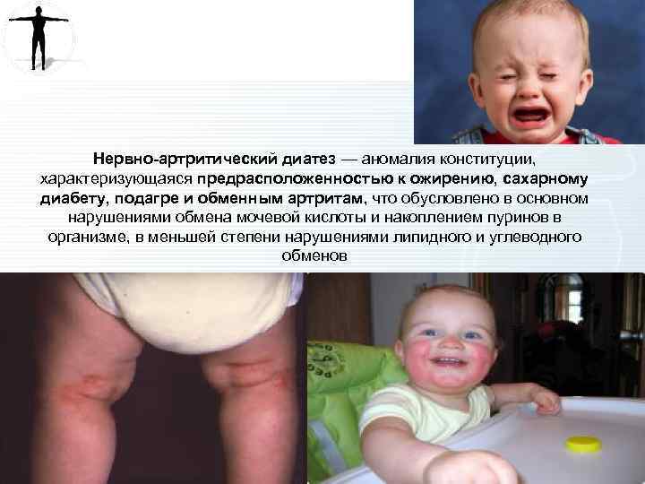 Нервно-артритический диатез — аномалия конституции, характеризующаяся предрасположенностью к ожирению, сахарному диабету, подагре и обменным