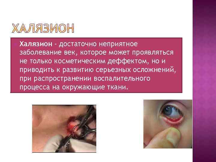  Халязион - достаточно неприятное заболевание век, которое может проявляться не только косметическим деффектом,