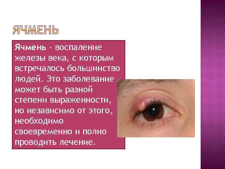 Ячмень - воспаление железы века, с которым встречалось большинство людей. Это заболевание может быть