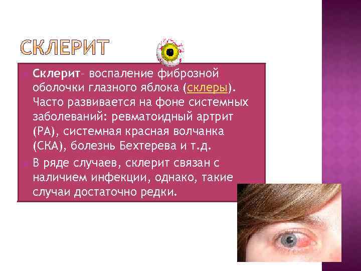 Склерит– воспаление фиброзной оболочки глазного яблока (склеры). Часто развивается на фоне системных заболеваний: ревматоидный
