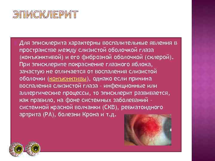  Для эписклерита характерны воспалительные явления в пространстве между слизистой оболочкой глаза (конъюнктивой) и