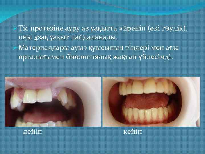 Ø Тіс протезіне ауру аз уақытта үйреніп (екі тәулік), оны ұзақ уақыт пайдаланады. Ø