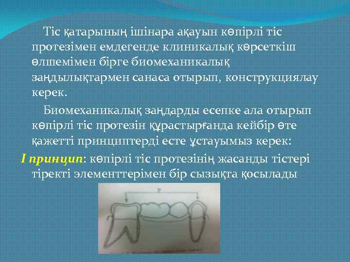 Тіс қатарының ішінара ақауын көпірлі тіс протезімен емдегенде клиникалық көрсеткіш өлшемімен бірге биомеханикалық заңдылықтармен