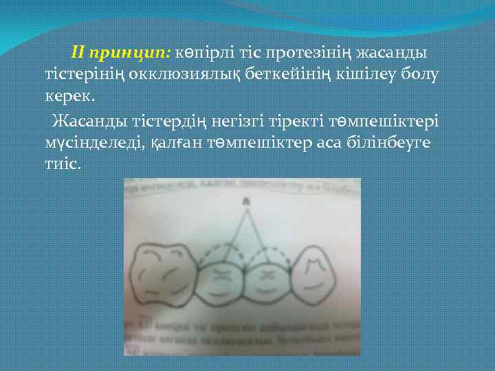 II принцип: көпірлі тіс протезінің жасанды тістерінің окклюзиялық беткейінің кішілеу болу керек. Жасанды тістердің