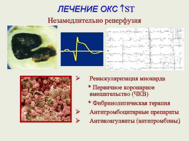 ЛЕЧЕНИЕ ОКС ST Незамедлительно реперфузия Ø Реваскуляризация миокарда * Первичное коронарное вмешательство (ЧКВ) *