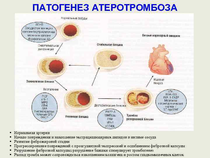 ПАТОГЕНЕЗ АТЕРОТРОМБОЗА § § § Нормальная артерия Начало повреждения и накопление экстрацеллюлярных липидов в