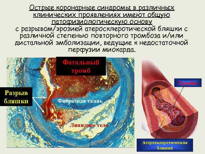 Острые коронарные синдромы в различных клинических проявлениях имеют общую патофизиологическую основу с разрывом/эрозией атеросклеротической