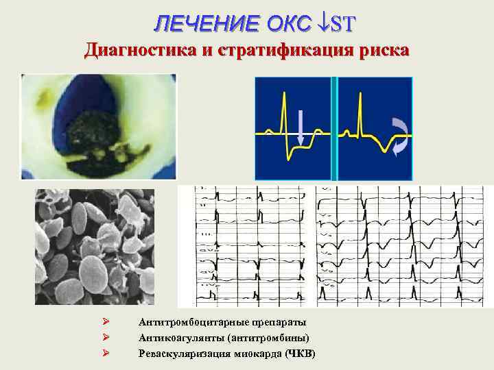 ЛЕЧЕНИЕ ОКС ST Диагностика и стратификация риска Ø Ø Ø Антитромбоцитарные препараты Антикоагулянты (антитромбины)