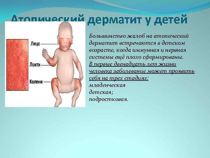 Атопический дерматит у детей Большинство жалоб на атопический дерматит встречаются в детском возрасте, когда