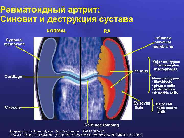 Ревматоидный артрит: Синовит и деструкция сустава NORMAL RA Inflamed synovial membrane Synovial membrane Pannus