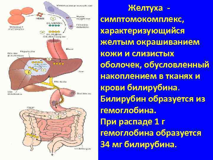 Желтуха симптомокомплекс, характеризующийся желтым окрашиванием кожи и слизистых оболочек, обусловленный накоплением в тканях и