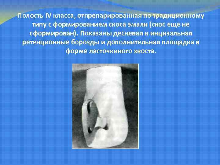 Полость IV класса, отпрепарированная по традиционному типу с формированием скоса эмали (скос еще не