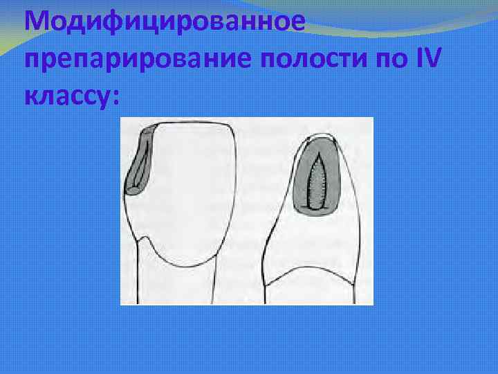 Пломбирование классов по блэку. Препарирование полостей 4 класса. Полость 4 класса пломбирование. Препарирование 4 класса по Блэку. Первый класс по Блэку препарирование.