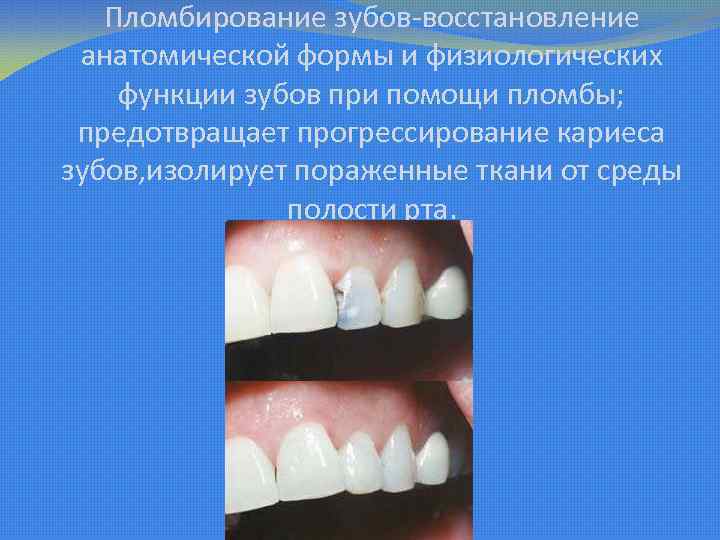 Пломбирование зубов-восстановление анатомической формы и физиологических функции зубов при помощи пломбы; предотвращает прогрессирование кариеса