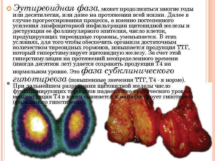  Эутиреоидная фаза, может продолжаться многие годы или десятилетия, или даже на протяжении всей