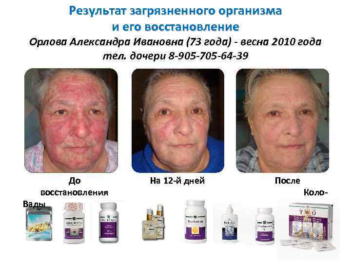 Результат загрязненного организма и его восстановление Орлова Александра Ивановна (73 года) - весна 2010