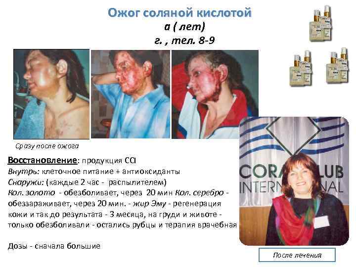 Ожог соляной кислотой а ( лет) г. , тел. 8 -9 Сразу после ожога