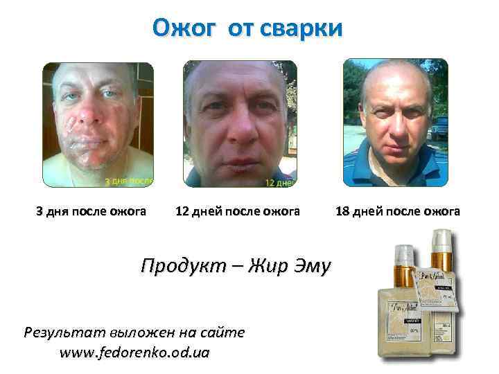 Ожог от сварки 3 дня после ожога 12 дней после ожога Продукт – Жир