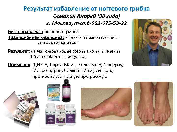 Результат избавление от ногтевого грибка Семакин Андрей (38 года) г. Москва, тел. 8 -903