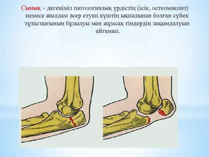 Сынық – дегеніміз патологиялық үрдістің (ісік, остеомиелит) немесе жылдам әсер етуші күштің ықпалынан болған