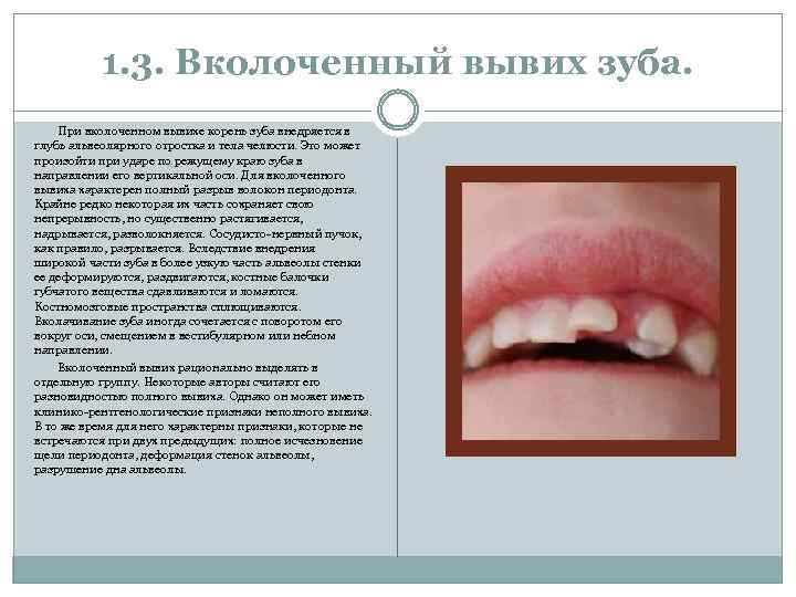 1. 3. Вколоченный вывих зуба. При вколоченном вывихе корень зуба внедряется в глубь альвеолярного