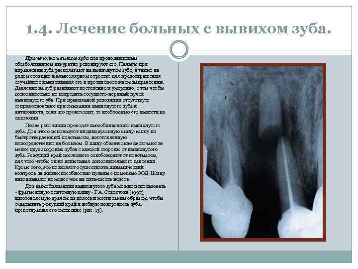1. 4. Лечение больных с вывихом зуба. При неполном вывихе зуба под проводниковым обезболиванием
