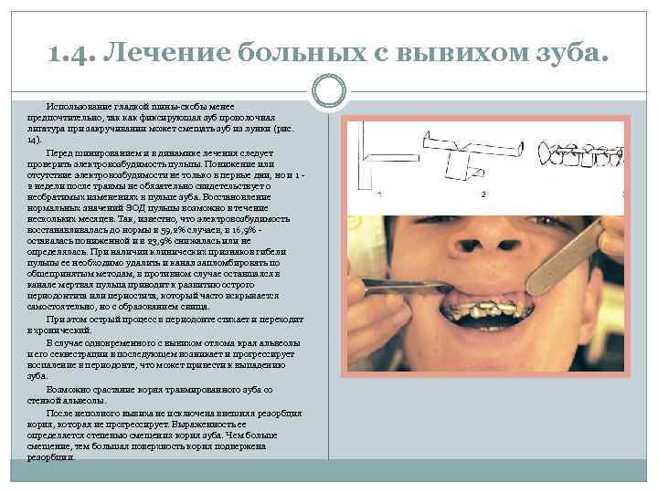1. 4. Лечение больных с вывихом зуба. Использование гладкой шины-скобы менее предпочтительно, так как