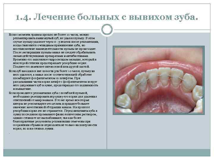 1. 4. Лечение больных с вывихом зуба. Если с момента травмы прошло не более