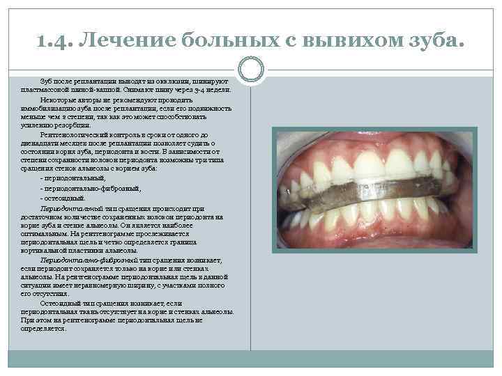 1. 4. Лечение больных с вывихом зуба. Зуб после реплантации выводят из окклюзии, шинируют