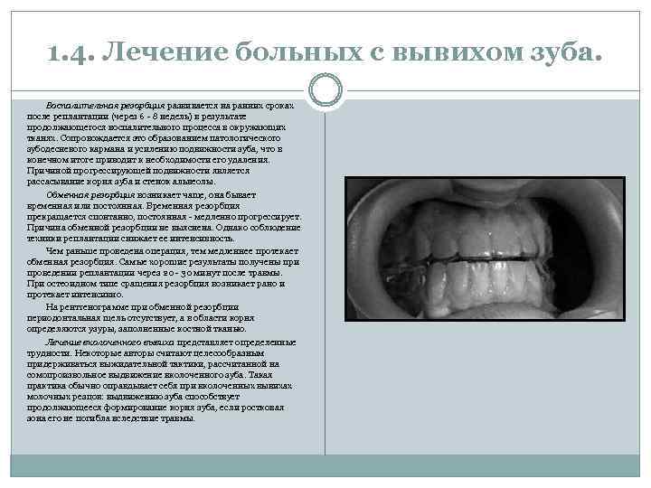 1. 4. Лечение больных с вывихом зуба. Воспалительная резорбция развивается на ранних сроках после