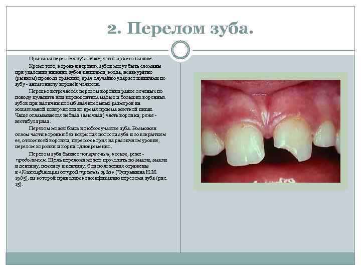 2. Перелом зуба. Причины перелома зуба те же, что и при его вывихе. Кроме