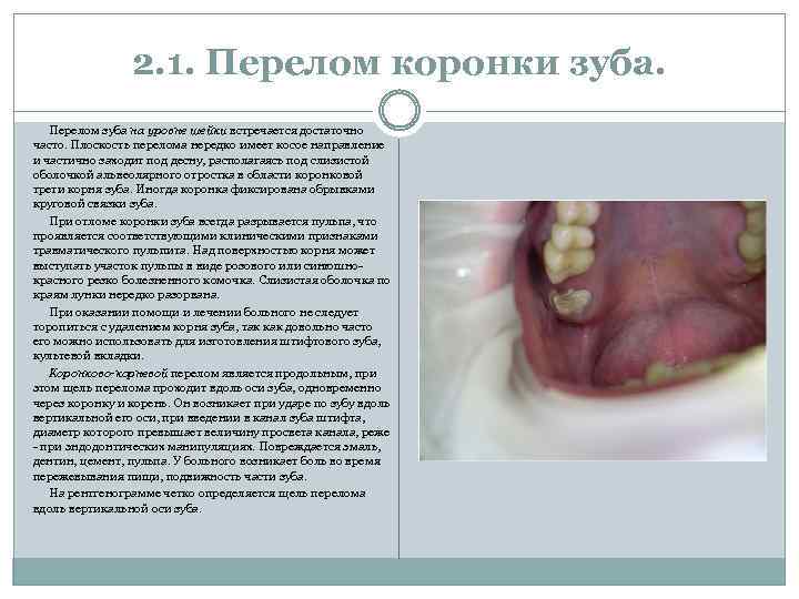 2. 1. Перелом коронки зуба. Перелом зуба на уровне шейки встречается достаточно часто. Плоскость