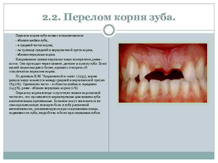 2. 2. Перелом корня зуба может локализоваться: - вблизи шейки зуба, - в средней