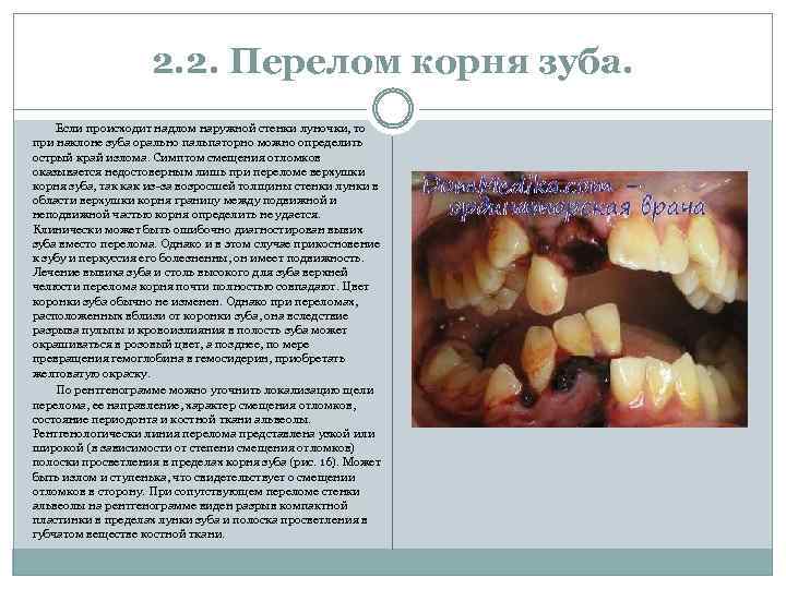2. 2. Перелом корня зуба. Если происходит надлом наружной стенки луночки, то при наклоне