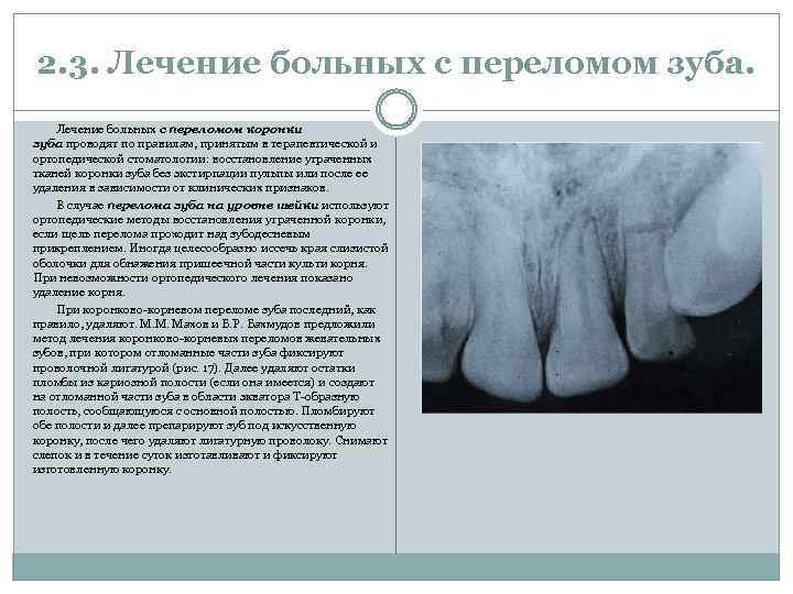 2. 3. Лечение больных с переломом зуба. Лечение больных с переломом коронки зуба проводят