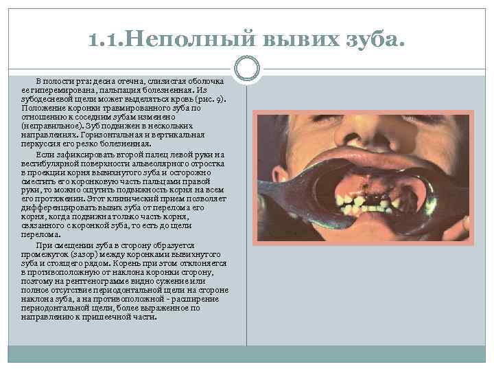 1. 1. Неполный вывих зуба. В полости рта: десна отечна, слизистая оболочка ее гиперемирована,