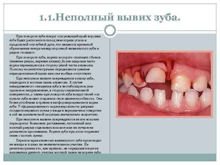 1. 1. Неполный вывих зуба. При повороте зуба вокруг оси режущий край коронки зуба