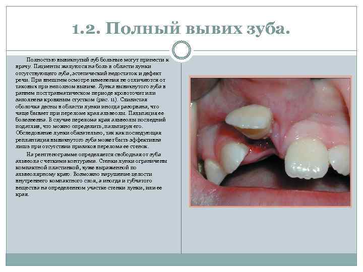 1. 2. Полный вывих зуба. Полностью вывихнутый зуб больные могут принести к врачу. Пациенты