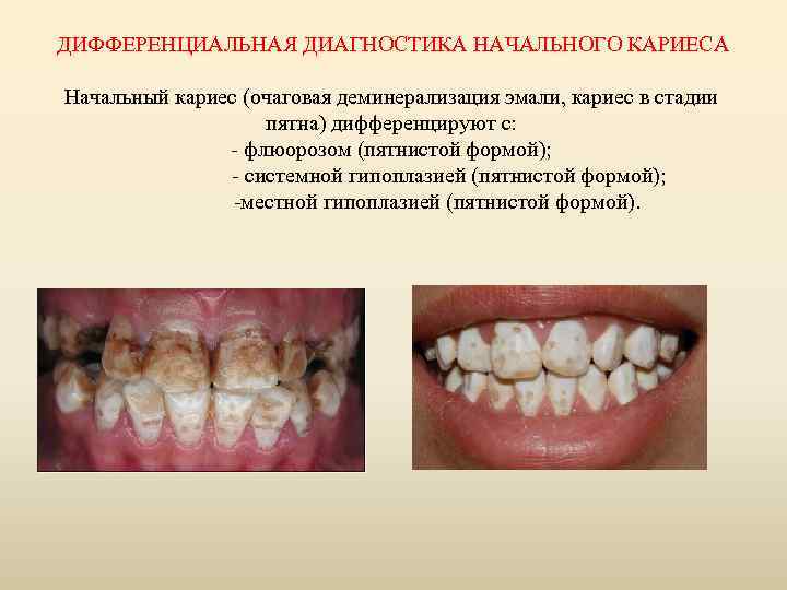 ДИФФЕРЕНЦИАЛЬНАЯ ДИАГНОСТИКА НАЧАЛЬНОГО КАРИЕСА Начальный кариес (очаговая деминерализация эмали, кариес в стадии пятна) дифференцируют