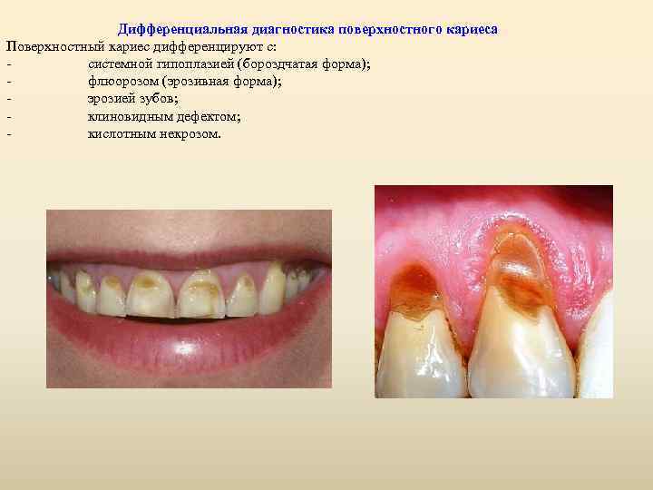 Дифференциальная диагностика поверхностного кариеса Поверхностный кариес дифференцируют с: - системной гипоплазией (бороздчатая форма);