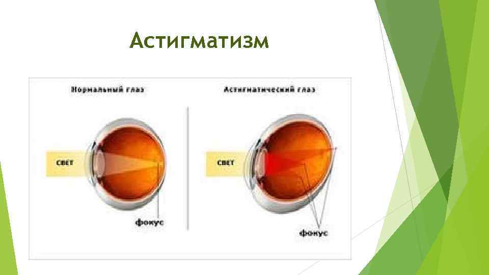 Астигматизм. Зрение у школьников анатомия. Астигматизм кабинет охраны зрения. Астигматизм сравнение.