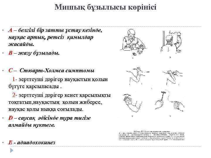 Мишық бұзылысы көрінісі • • • А – белгілі бір затты ұстау кезінде, науқас