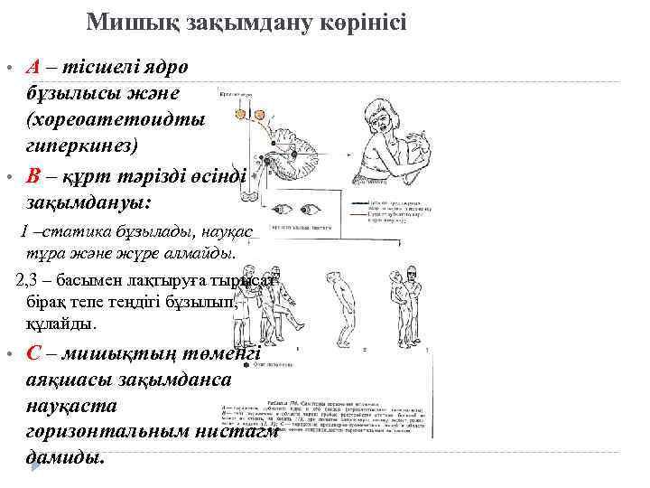 Мишық зақымдану көрінісі • • А – тісшелі ядро бұзылысы және (хореоатетоидты гиперкинез) В