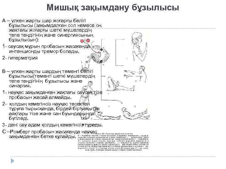 Мишық зақымдану бұзылысы А – үлкен жарты шар жоғарғы бөлігі бұзылысы (зақымдалған сол немесе