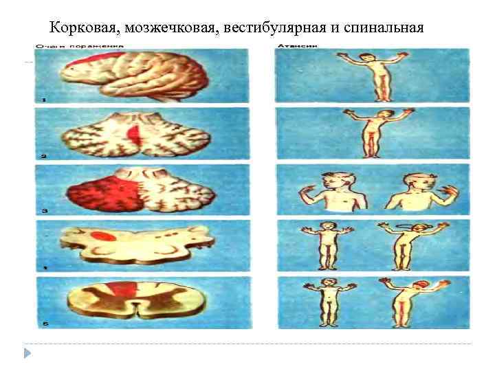 Корковая, мозжечковая, вестибулярная и спинальная атаксии 