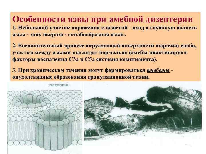 Особенности язвы при амебной дизентерии 1. Небольшой участок поражения слизистой - вход в глубокую